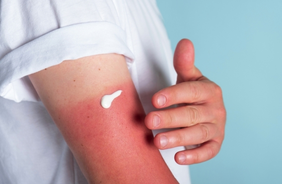 crema-hidrocortizon