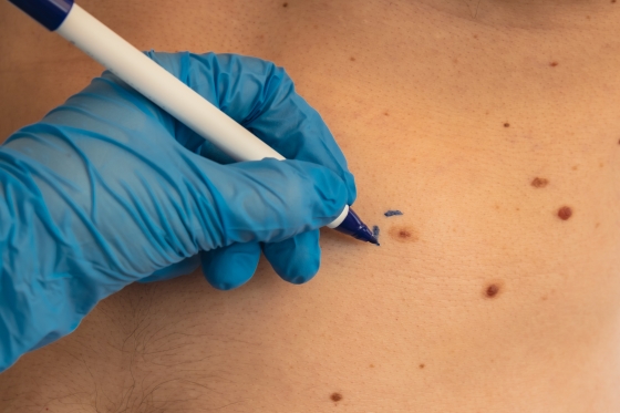 cancer-de-piele-tratament