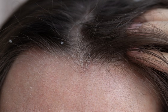 Ciuperca-scalp