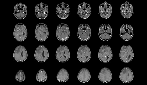 Craniofaringiomul