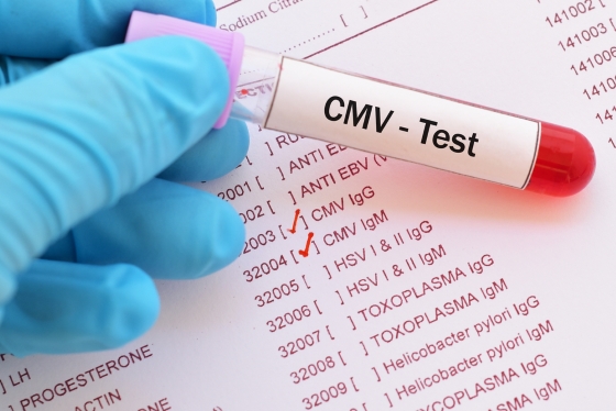 infectia-cu-citomegalovirus-diagnostic