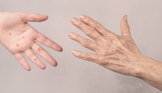 infectia-cu-virusul-Coxsackie-la-copii-si-adulti