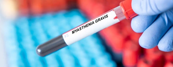 miastenia-gravis-simptome