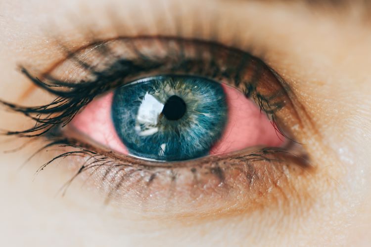 scăderea acuității vizuale ochi roșii