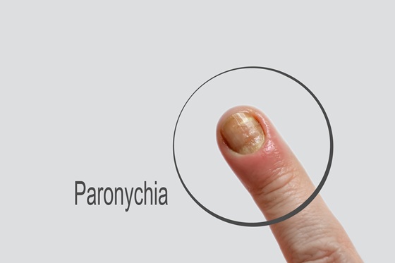 Paronichia