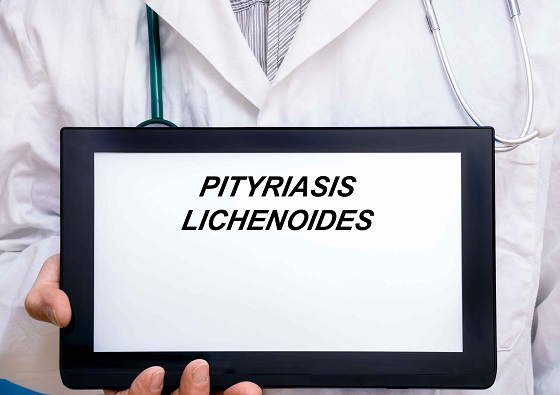 Pitiriazis-lichneoid-cronic
