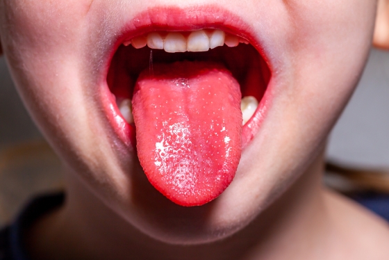 scarlatina-simptome-limba-capsuna