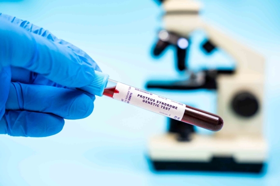 sindrom-Proteus-diagnostic