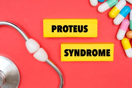 sindrom-Proteus-cauze-simptome-tratament