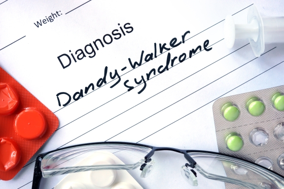 sindromul-Dandy-Walker-diagnostic