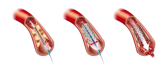 stent-la-inima