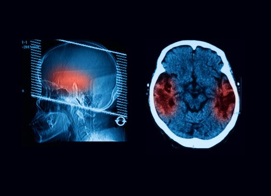 atrofie-cerebeloasa-cauze-simptome-diagnostic-tratament