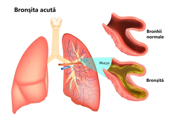 bronsita-simptome