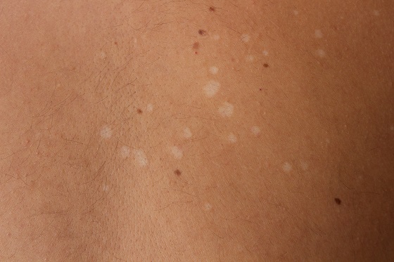 crema-pitiriazis
