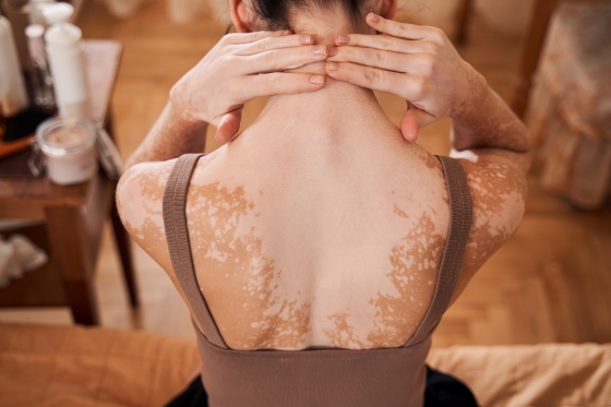 despre-vitiligo-cauze-factori-de-risc-diagnostic-si-tratament