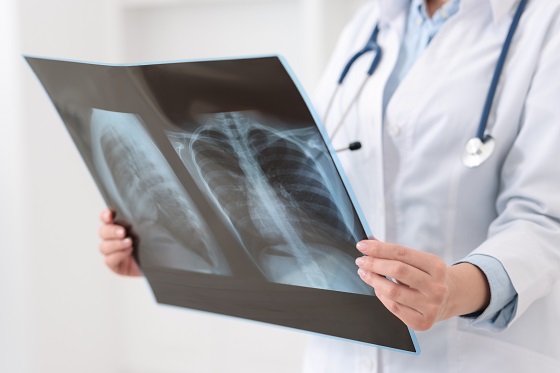 fibroza-pulmonara