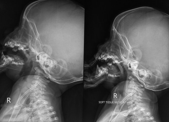 infectia-osului-mastoid