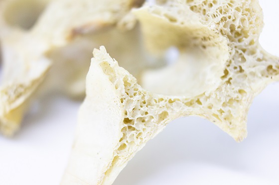 osteoporoză
