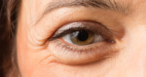 Cum să reduci aspectul ridurilor de sub ochi - Doza de Sănătate