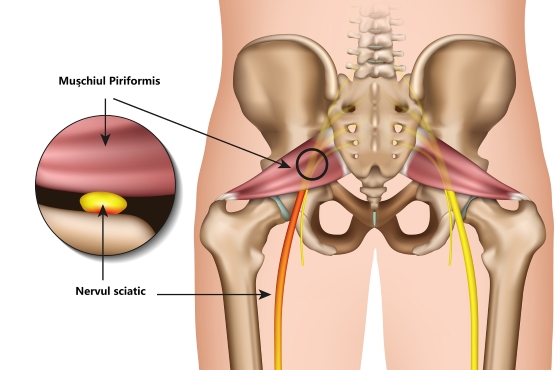 pierdere în greutate durere sciatica)