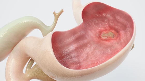 Dieta pentru ulcerul peptic: 6 recomandări