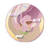 infectia tractului urinar