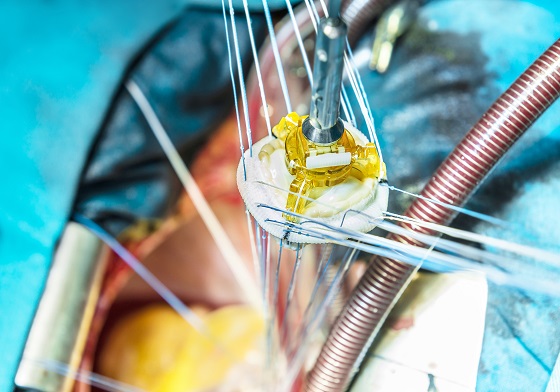 valve-cardiace-artificiale