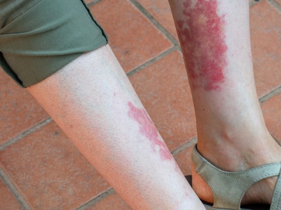poate lupus să vă piardă în greutate