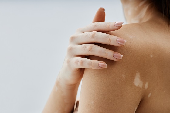 vitiligo